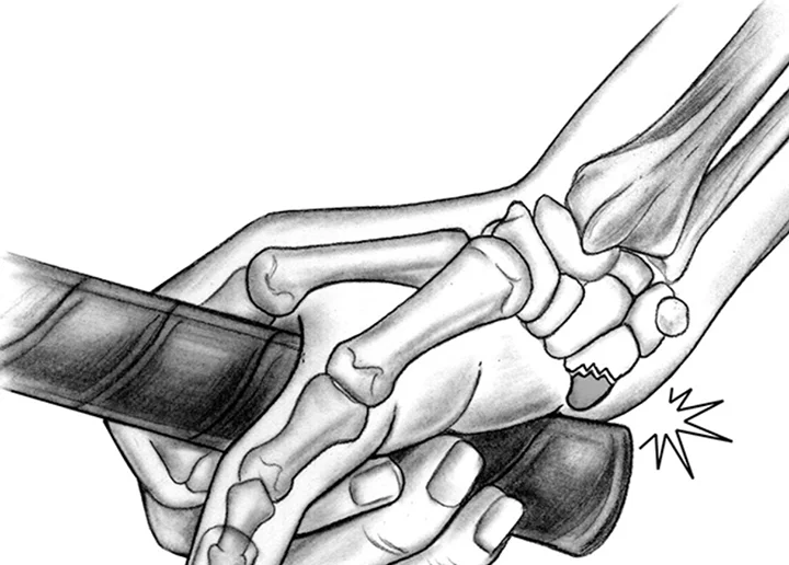 Image of a diagram shows an anatomical overlay of the hand and wrist bones, highlighting a fractured hook of hamate bone at the base of the palm where it impacts the knob of the handle